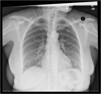 TB Xray - notice the cavitation on L lung.
